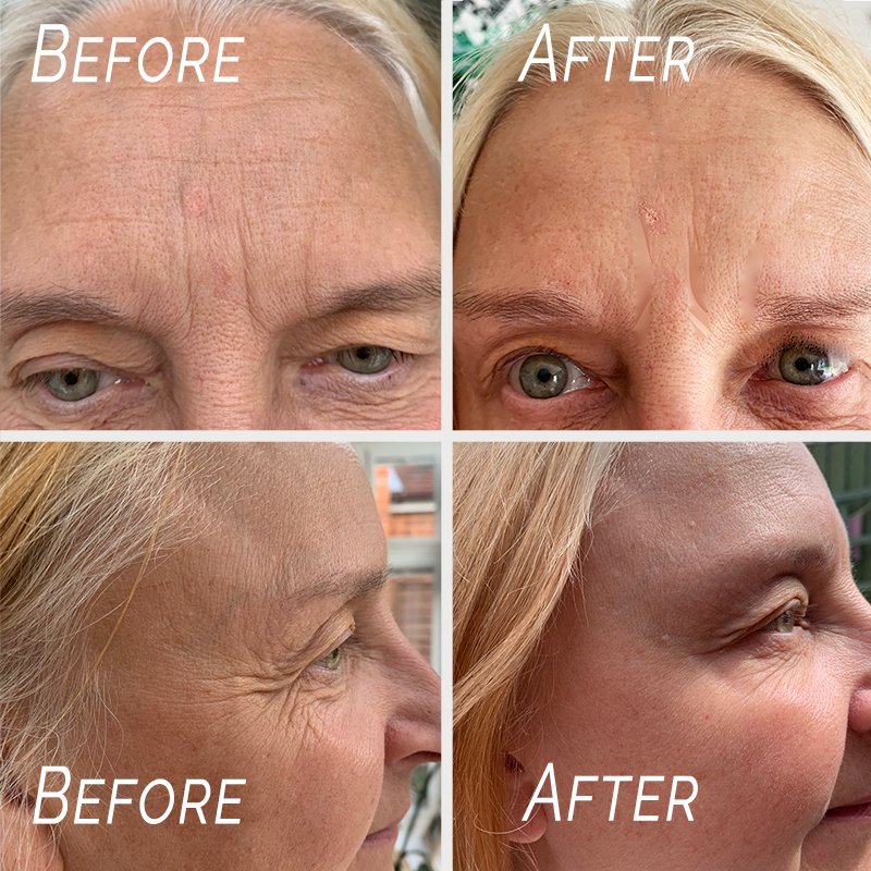 Life Mind Body by Karen Howell, Massage Therapist in Wokingham - Botox Injections